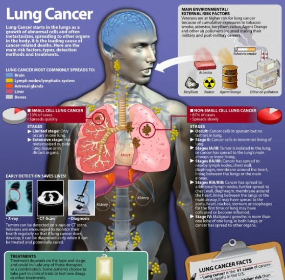 lung cancer facts & statistics 1