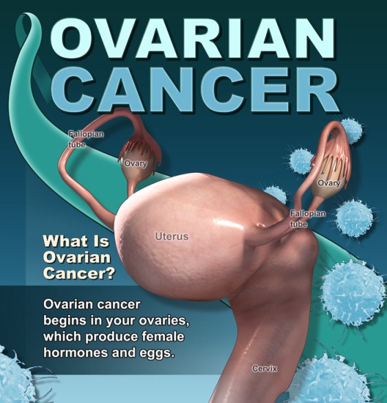 What is Ovarian Cancer